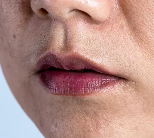 Lip Pigmentation Treatment